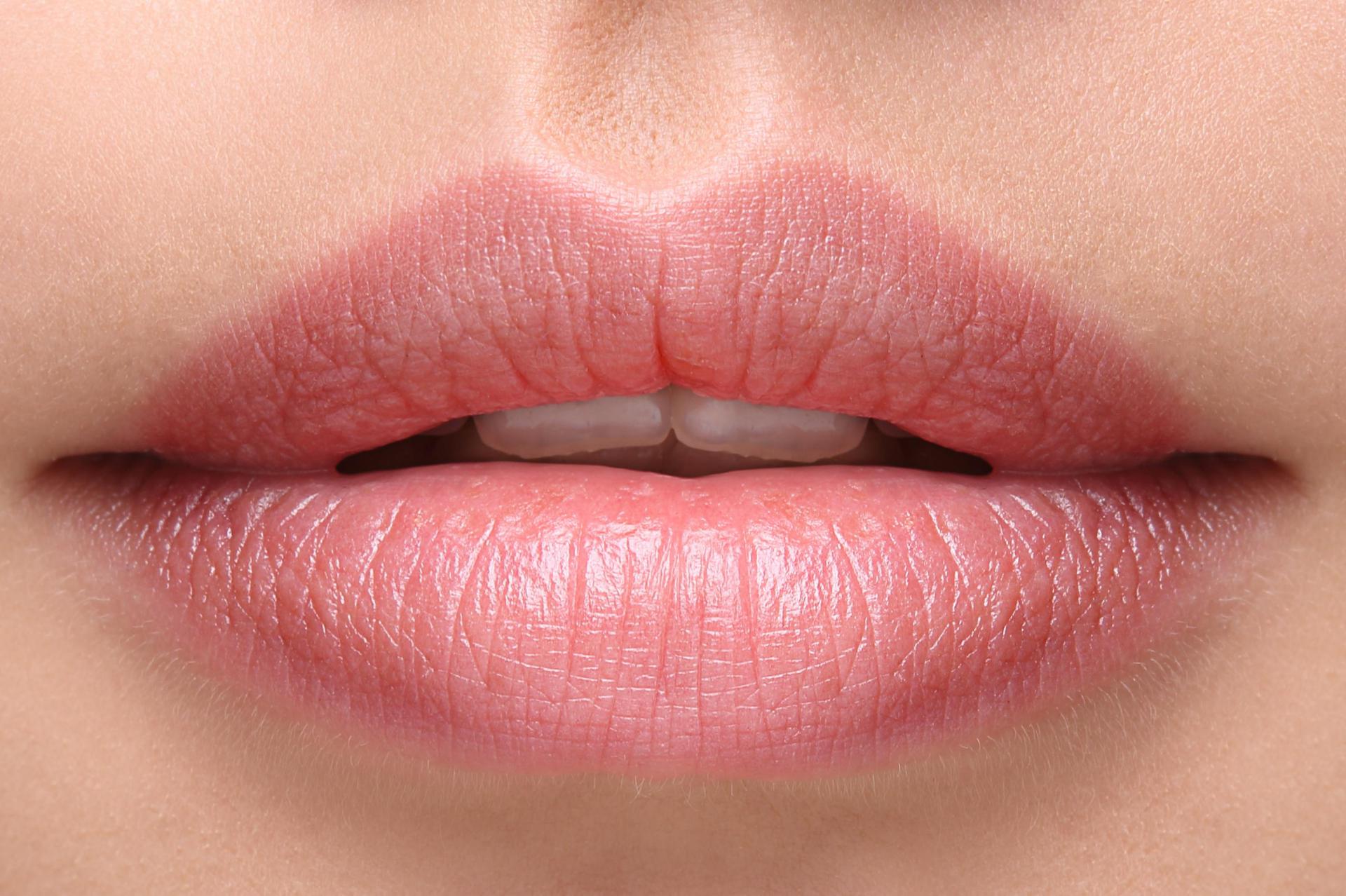 Volume treatment with Hyaluron